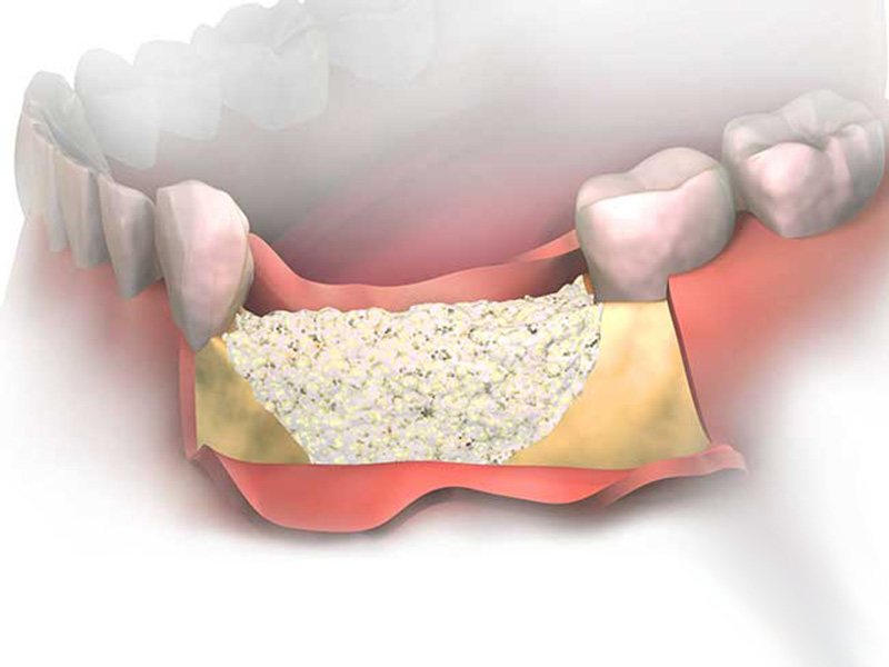 Bone Grafting - Portland Dental, OR