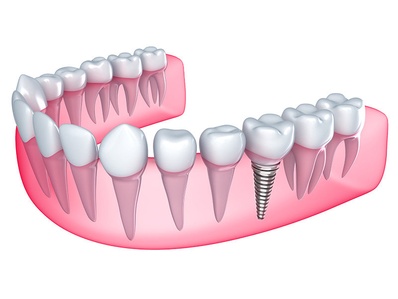 Dental Implants - Portland Dental, OR