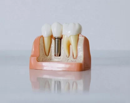 When Are Dental Implants a Good Solution? 