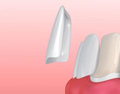 Does Your Smile Lack Aesthetic Appeal? Try Porcelain Veneers 