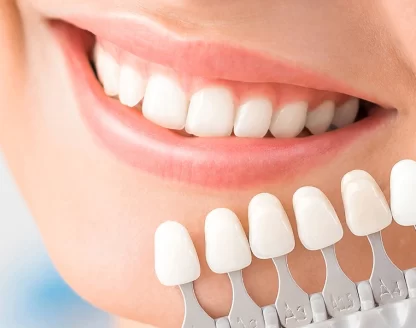 What You Should Know About Getting Teeth Veneers 