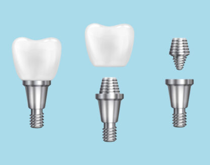 An introduction to getting implants to replace one tooth or to completely make over your smile 
