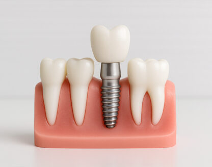 What to Expect: A 7-Step Guide to Dental Implants in Portland 