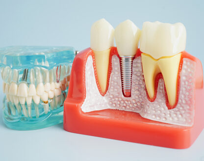 4 reasons implants are a popular choice to replace teeth 