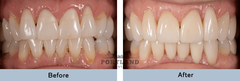 Dental Veneers Before and After Result