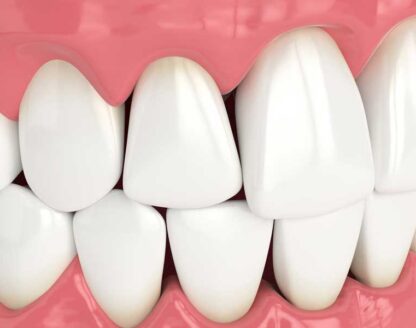 Covertly Straighten Your Teeth with Invisalign® Dental Aligners 