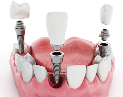 Dental Implant Placement Basics as a Step-by-Step Process 