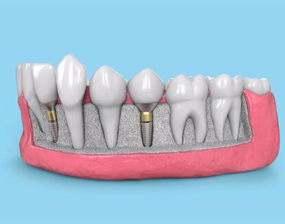 Dental Implants: What Should I Expect from Treatment? 