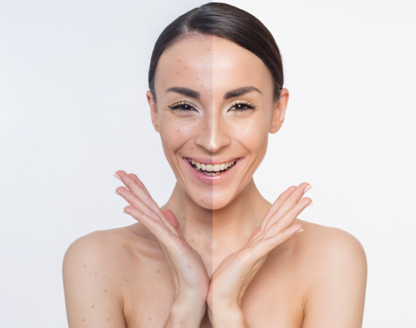 Dental Veneers Can Improve the Appearance of a Smile Suffering from Multiple Cosmetic Imperfections 