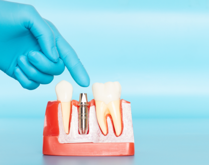 How to Prevent Enamel Erosion and Cavities 