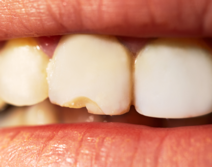 How to Treat a Cracked Tooth 