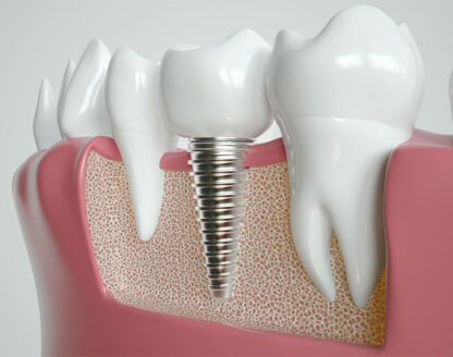 Dental Implants: Are They a Wise Choice for You? 