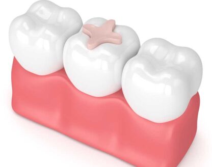 Teeth-Whitening Gel Can Be Used to Whiten Moderately Stained Tooth Enamel 