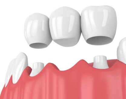The Facts About Dental Bridges 