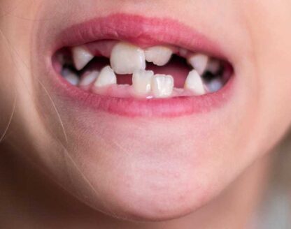 What to Do for Your Missing Teeth 