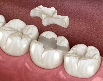 What to Watch Out for if You Suspect One of Your Fillings Is Going Bad 